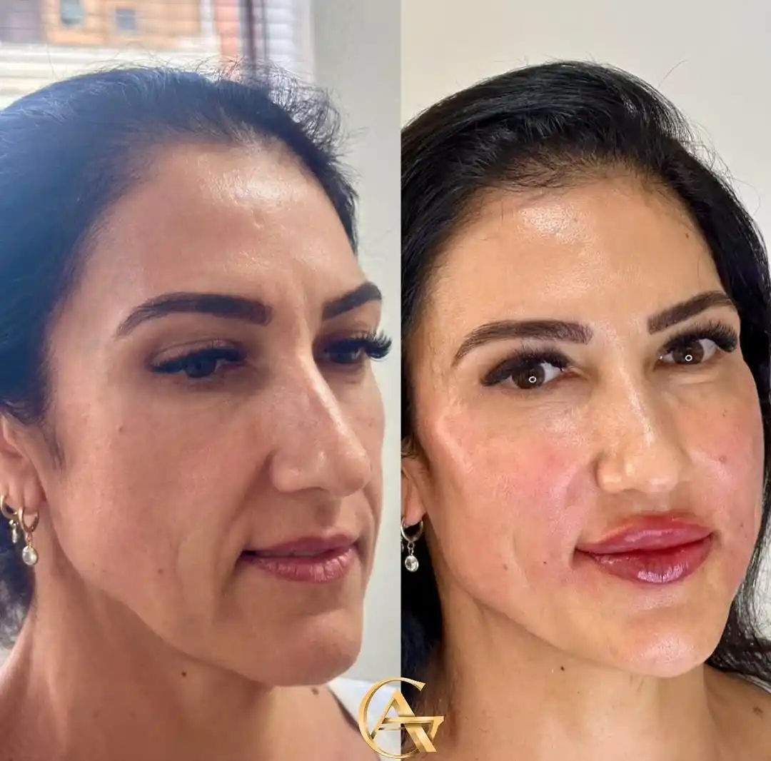 Resultado autorizado de harmonização facial natural em Itaúna e Pará de Minas