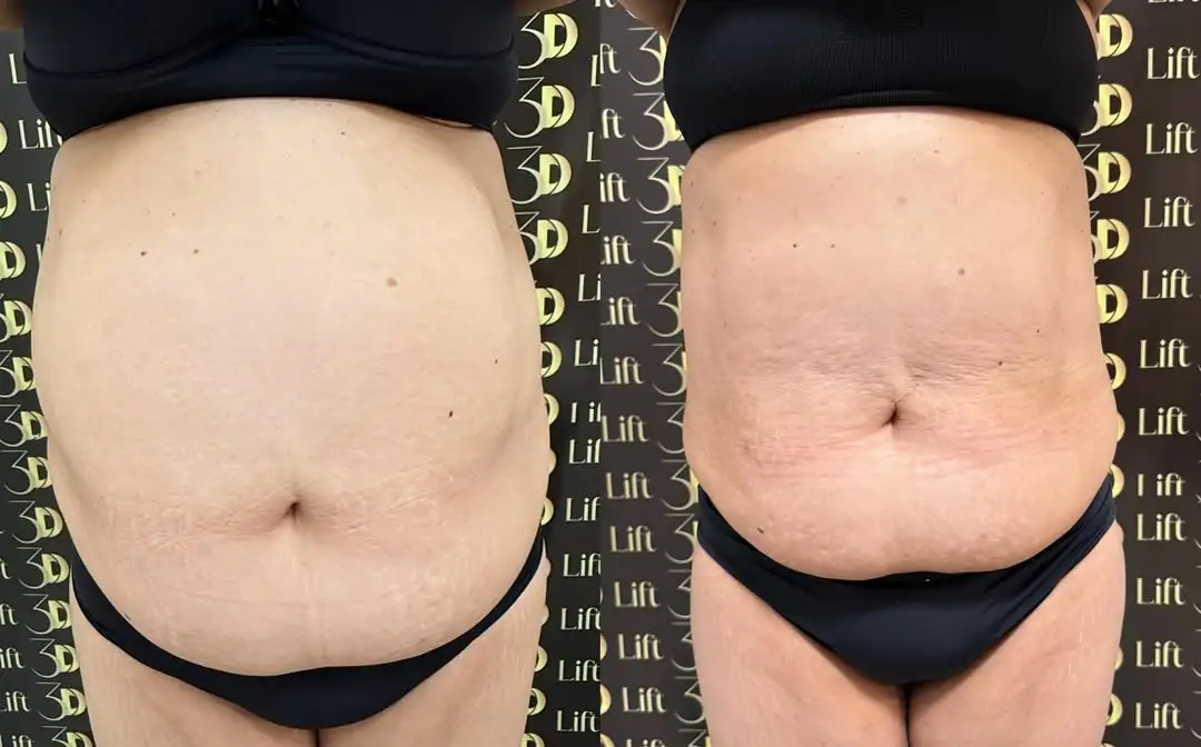 Tratamento Lift 3D para harmonização corporal e contorno abdominal em Itaúna e Pará de Minas